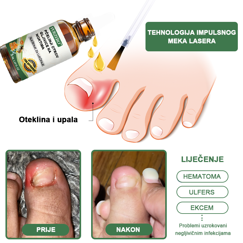 👩‍⚕️Furzero™ Ošetrujúce sérum proti včelímu jedu na nechty