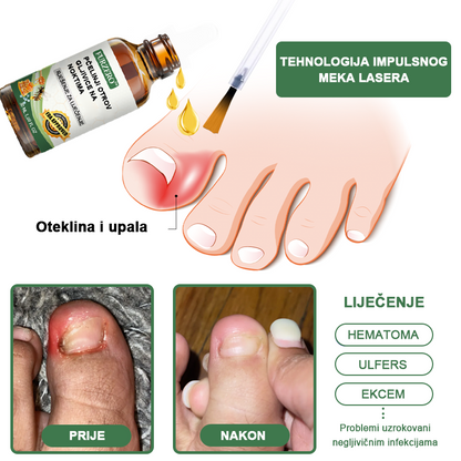 👩‍⚕️Furzero™ Ošetrujúce sérum proti včelímu jedu na nechty