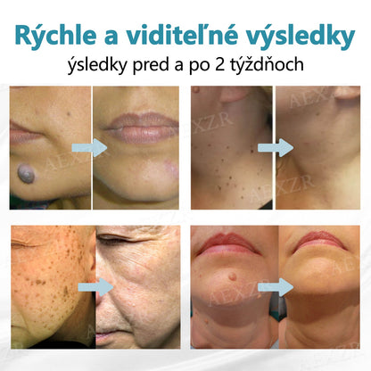Bikenda® Neinvazívne laserové pero na odstránenie znamienok a bradavíc